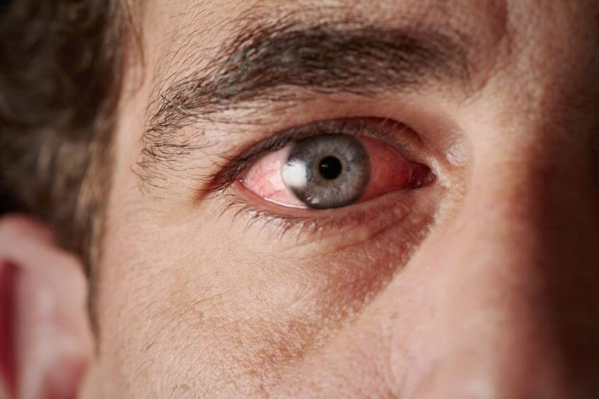 Pink Eye Everything You Need to Know Urgentology Care